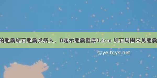 现一无症状的胆囊结石胆囊炎病人。B超示胆囊壁厚0.4cm 结石周围未见胆囊腔 胆囊肿胀